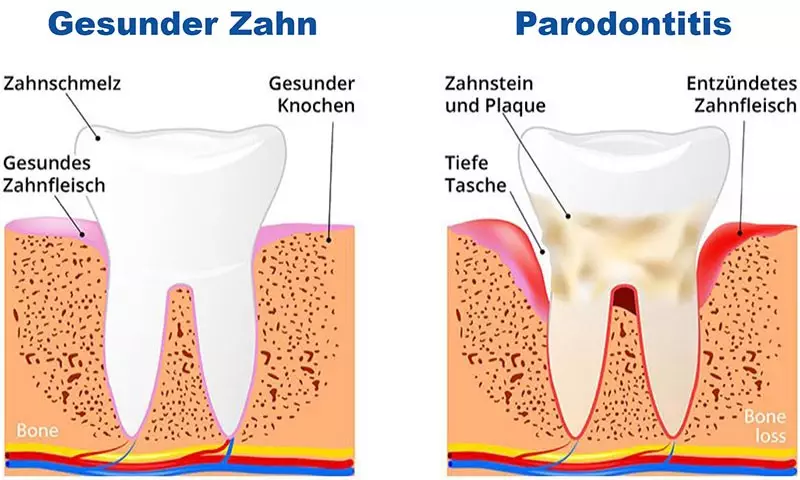 Parodontitis Abbildung