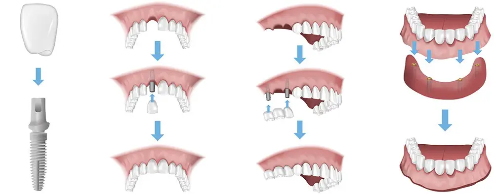 Bilderbau Implantate